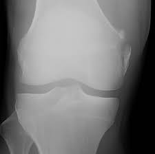 Mcl Medial Collateral Ligament Tear Strain - Athletic Physical Therapy