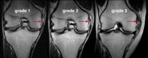 Mcl Medial Collateral Ligament Tear Strain - Athletic Physical Therapy